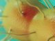 Super-gonorrhoea